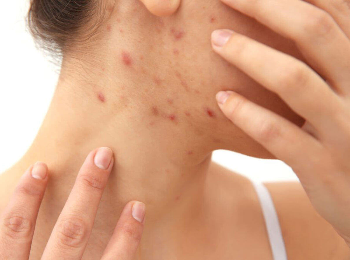 Acne and Vegan-Based Protein: Is There a Connection?